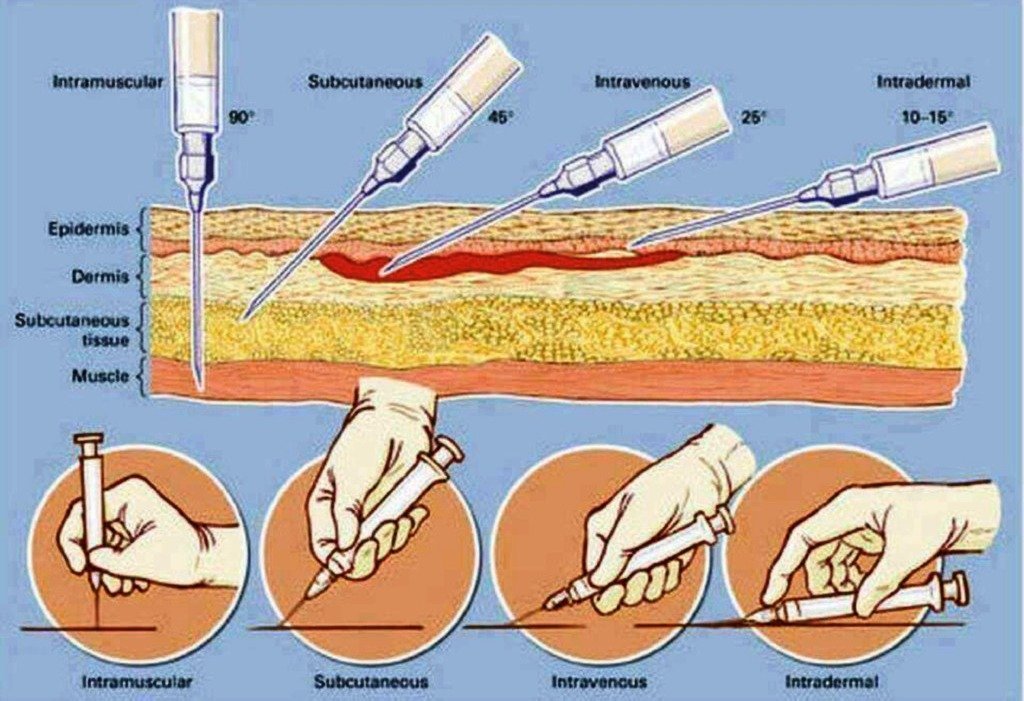 Intramuscular Injection