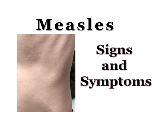 measles, definition, signs and symptoms, complications, prevention, treatment